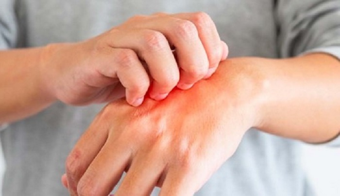 Alergi Dingin – Faktor Pengaruh, Pencegahan & Mengatasinya