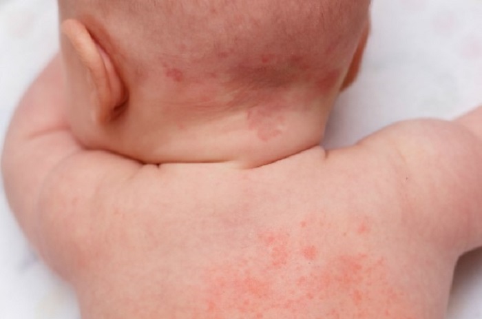 Alergi Pada Bayi – Apa yang Harus Ibu Ketahui