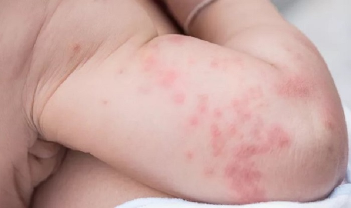Gejala Alergi Pada Anak Beserta Pengaruhnya