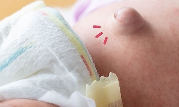 Hernia Pada Bayi, Berbahayakah?