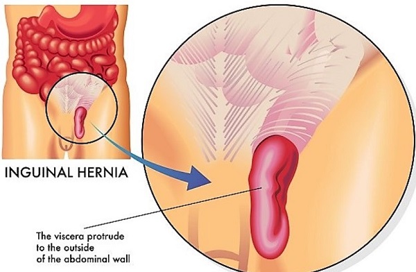 Mencegah dan Mengatasi Hernia Inguinalis